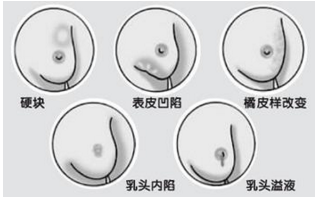 乳房湿疹症状及诊断